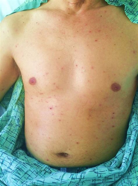 Presence Of Diffuse Vesicular Rash In Various Stages Of Development