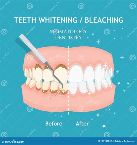 Teeth Whitening and Bleaching Concept in Flat Style. Dentistry and