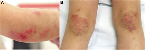 Inverse Gottron Papules And Auricular Red Violaceous Macules Anti Mda