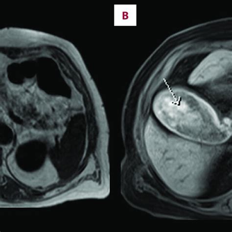 Axial T A And T Fs B Weighted Images From Non Contrast Mri