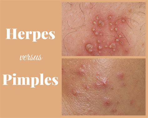 How To Tell The Difference Between Herpes And Pimples With Photos Healdove