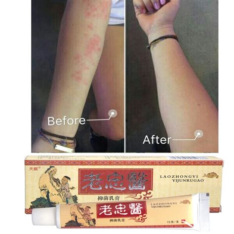 Psoriasis Eczema Treatment Anti Bacterial Skin Fungus Cream Shopee Malaysia