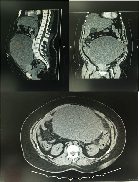 Preoperative Ct Scan Image Download Scientific Diagram