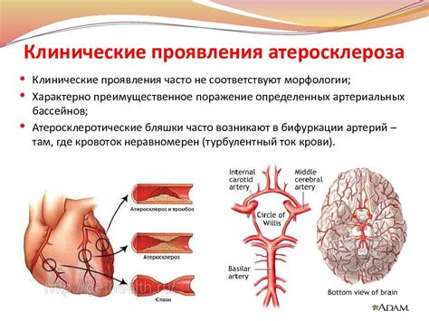 Атеросклероз — презентация