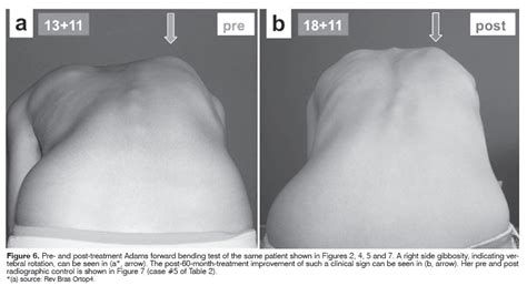 SciELO Brasil The Spine Lateral Bending And The Dynamic Chest