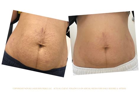 Laser Stretch Mark Removal Stretch Mark Treatment Las Vegas Stretch