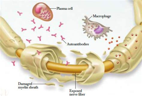 Polyneuropathy Types Demyelinating polyneuropathy barre inflammatory ...