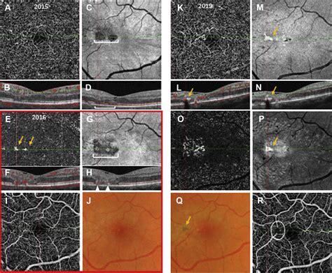 OCT Of Outer Retinal Hyperreflectivity Neovascularization And Pigment