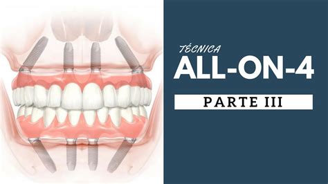 6 TÉCNICA ALL ON 4 PARTE 3 O mito de quanto mais implantes melhor