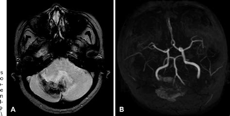 Figure From Remote Cerebellar Hemorrhage After Surgery For