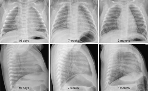 Pulmonary Vascularity Radiology Key