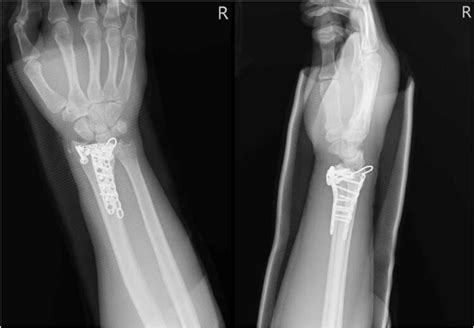 Right wrist X-ray showing a fracture located at the distal radius and ...