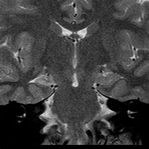 Mesial Temporal Sclerosis Right Image