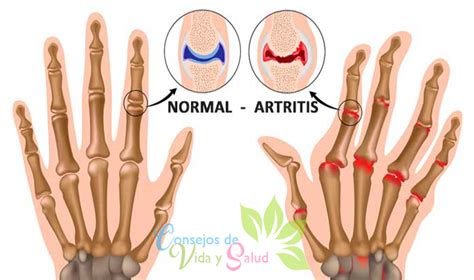 El Dolor En Las Articulaciones De Los Dedos Nmente Es El Primer