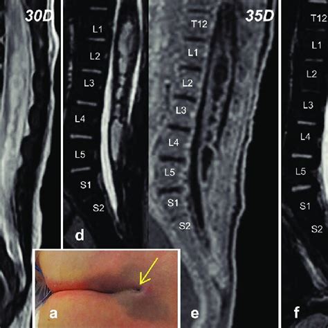 A Photograph Showing A Dimple At The Lumbosacral Region Continuous