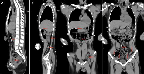 Frontiers Case Report Ventriculoperitoneal Shunt Disconnection