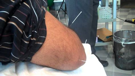 Acupuncture Of The Elbow Acupuncture Points Youtube