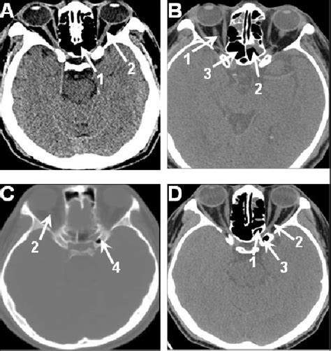 The Types Of Optic Nerve Near The Sphenoid Sinus Optic Nerve On Is