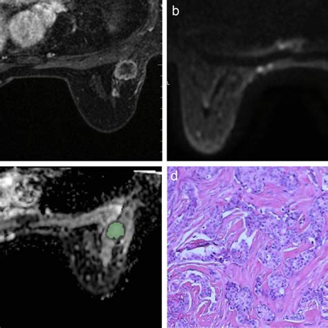 A Year Old Woman With Axillary Node Metastasis Was Found In