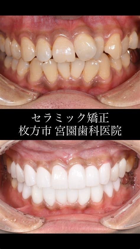 セラミック矯正について｜枚方市の歯医者｜小児歯科からインプラントまで｜宮園歯科医院