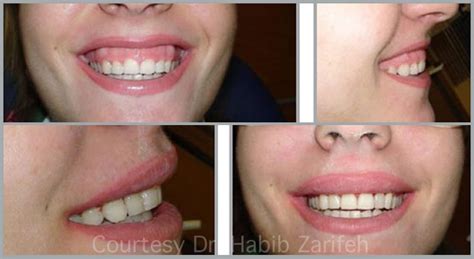 Gummy Smile Treatment In Beirut Lebanon