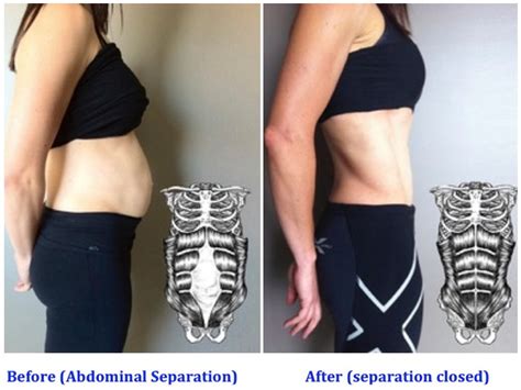 Do You Have A Mummy Tummy That Won T Go Away You May Have Diastasis