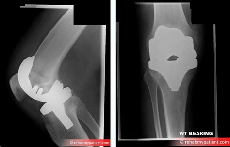 Knee Replacement | Rehab My Patient