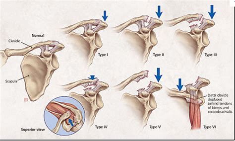 Shoulder Special Test For Msk Flashcards Quizlet