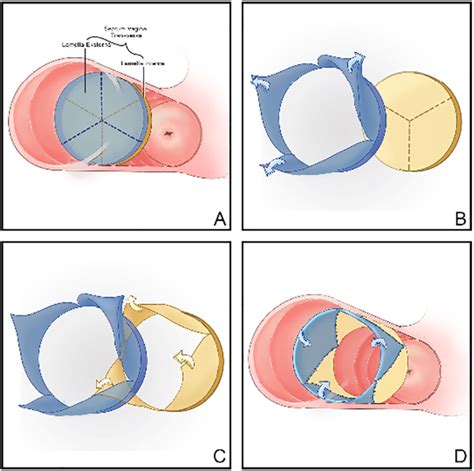 The Step Of Interdigitating Y Flaps Technique A The Vaginal Septum