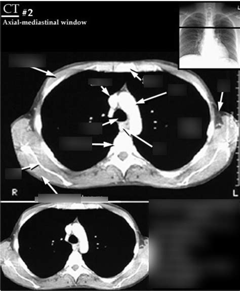 Ct Scans Of Thorax 2 Diagram Quizlet