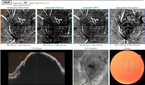 Swept Source Optical Coherence Tomography Angiography In Optic Disc Melanocytoma Canadian