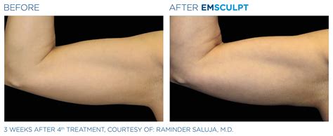 Emsculpt Arms 075 Zcosmetic Health
