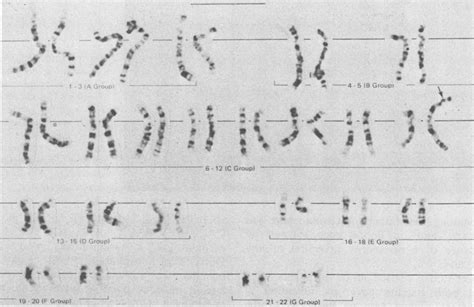 Trypsin Giemsa Banded Karyotype Ofan Early Metaphase Showing A