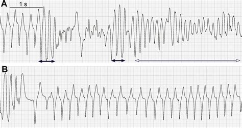 Cardiac Arrhythmias In Horses Veterinary Clinics Equine Practice