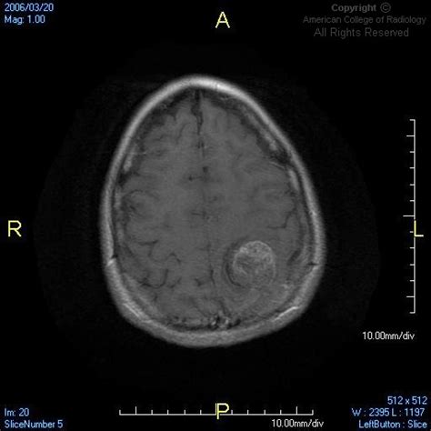 Neuroradiology On The Net Supratentorial Primitive Neuroectodermal Tumor S Pnet