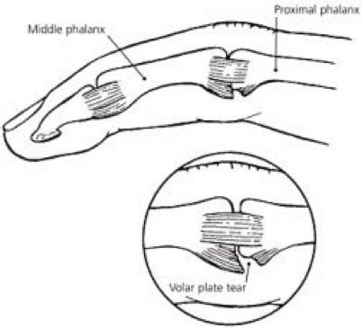 Ouch I Jarred My Finger Volar Plate Injuries Canberra Hand Therapy