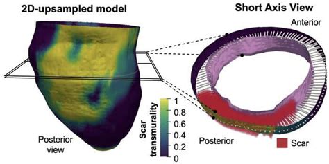 3d Mapping Of Post Infarction Scarring Increases The Prognostic