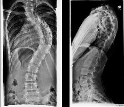 Scoliosis Johns Hopkins Medicine