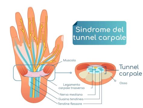 Tunnel Carpale Intervento E Chirurgia