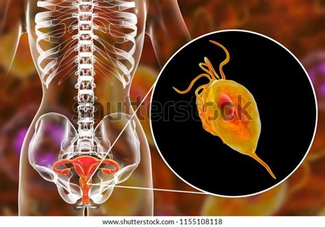 Female Trichomoniasis D Illustration Showing Vaginitis