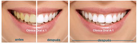 Blanqueamiento Dental Precio Paquetes Quir Rgicos