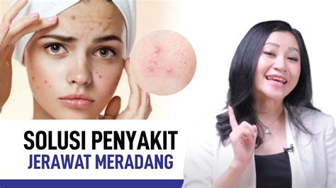 Jerawat Meradang Penyebab Gejala Dan Cara Mengatasi KATA DOKTER