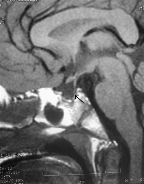 T1 Weighted Sagittal Section Mri Image Showing A Partial Empty Sella