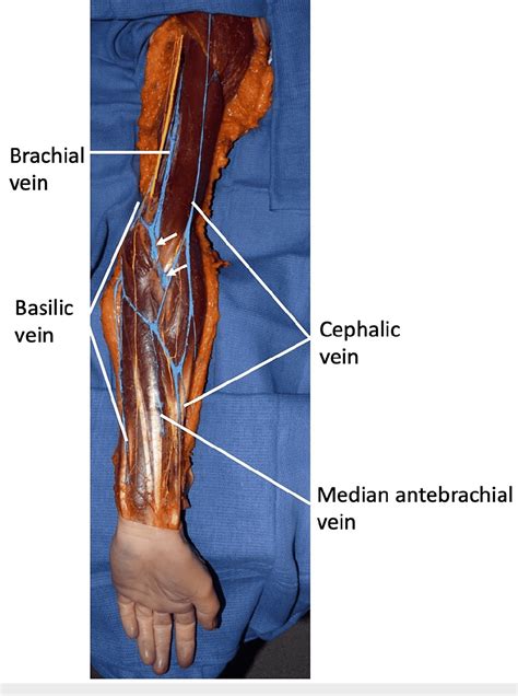 Figure 1 From Median Cubital Vein Traveling Deep To The Bicipital