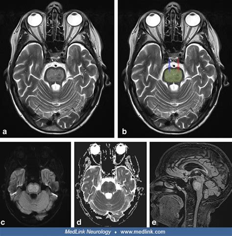 Alcoholic Woman Hospitalized For Wernicke Encephalopathy Presented