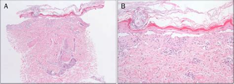 Microscopic Findings H E A A Dermal Epidermal Separation And A