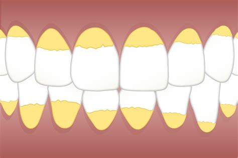 Sarro dental Por qué se forma y cómo eliminarlo Clinica Dental