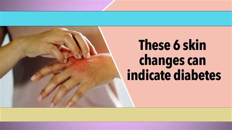 These Skin Changes Can Indicate Diabetes Lifestyle Times Of India