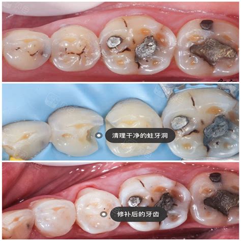 有没有为了看牙医而崩溃的终于修补好了我的继发龋 贝色口腔