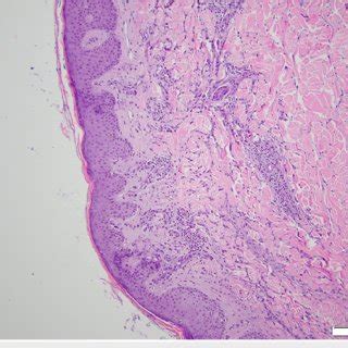 Low Power Examination Of A Mm Punch Biopsy From The Patient S Back